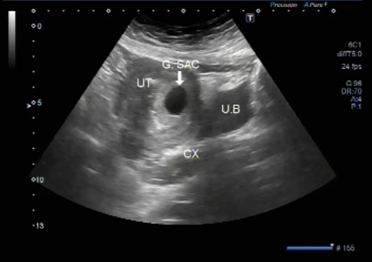 7 Week Ultrasound What To Expect Fetal Vision Imaging